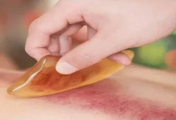 Kui kaua kulub ekhümoosi kadumiseks pärast Gua Sha't?